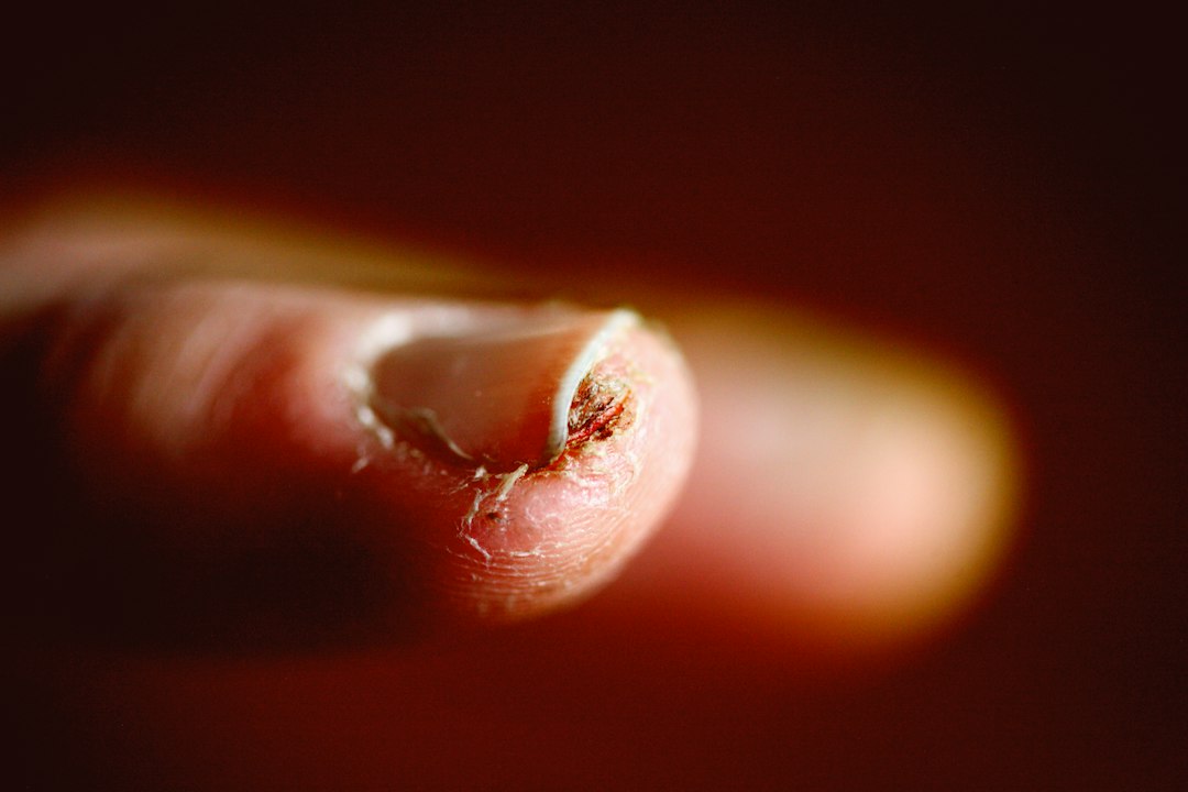 Fungal Nail Infections: Why They Spread and How to Stop Them